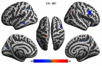 Altered Brain Structure and Spontaneous Functional Activity in Children With Concomitant Strabismus